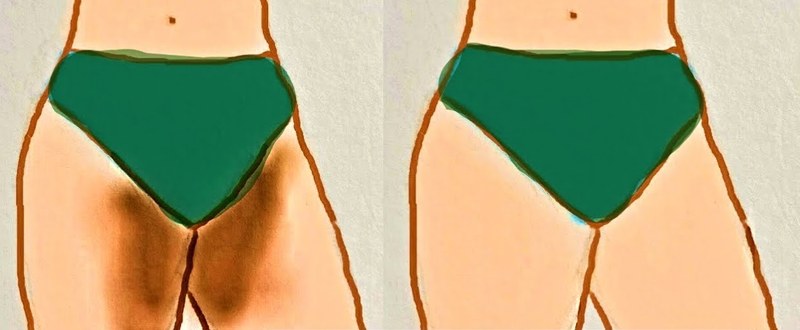 Illustration avant et après fournie par la structure